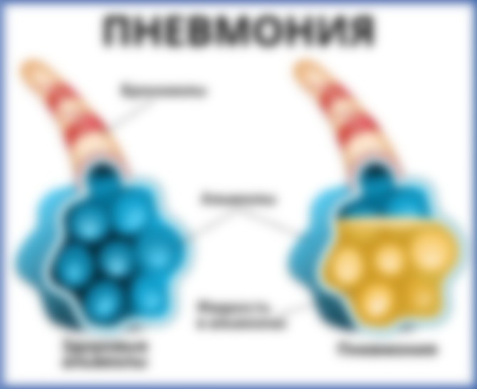 Пневмония — лечение и симптомы заболевания у взрослых и детей