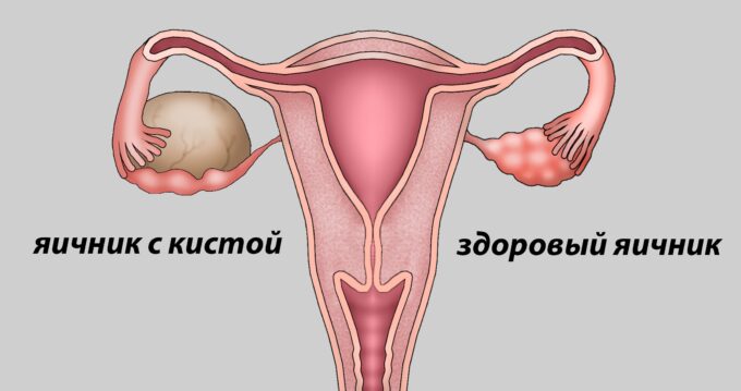 Полостная операция по удалению кисты яичника: когда нужна и особенности