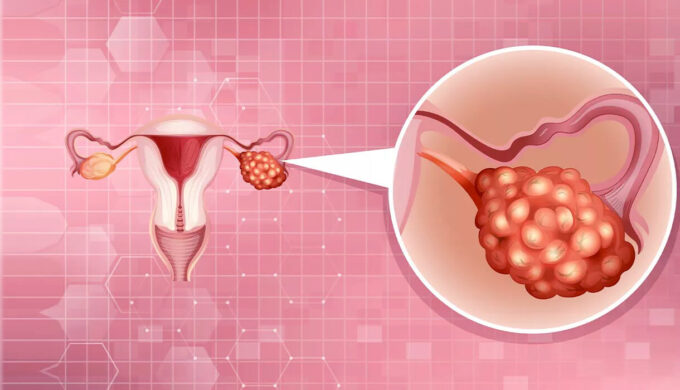 Полостная операция по удалению кисты яичника: когда нужна и особенности
